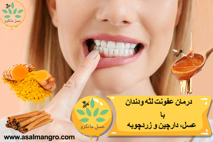درمان عفونت لثه و دندان با عسل