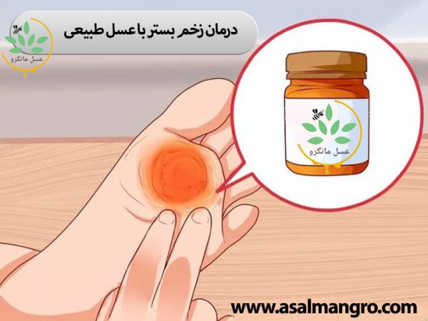 درمان زخم بستر با عسل طبیعی
