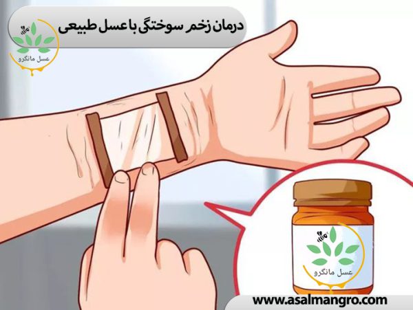 درمان زخم سوختگی با عسل طبیعی